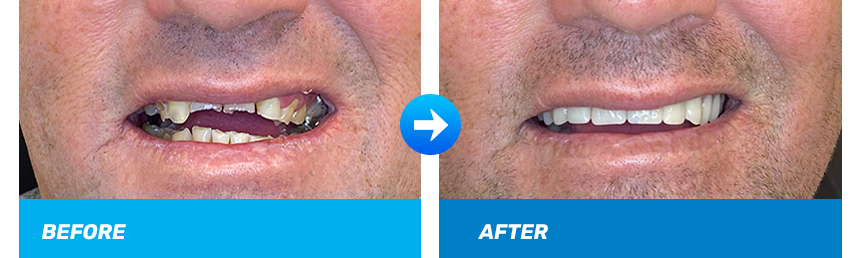 all-on-4-dental-implant-before-and-after-resized.png