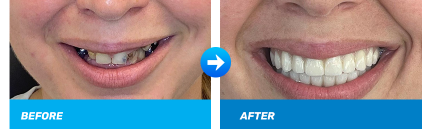 kh-before-after-all-on-four.png