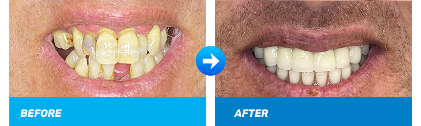 rl-before-after-all-on-four.png