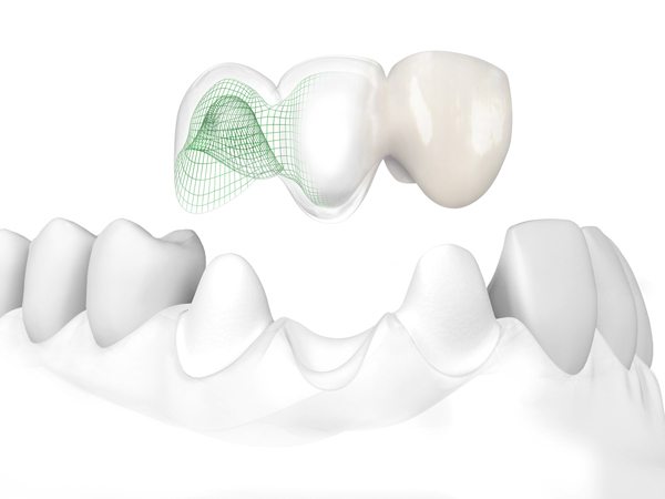 Example of conventional bridge work showing how the surrounding teeth need to be reducted to fit the dental bridge