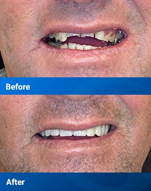 Before and after dental implants
