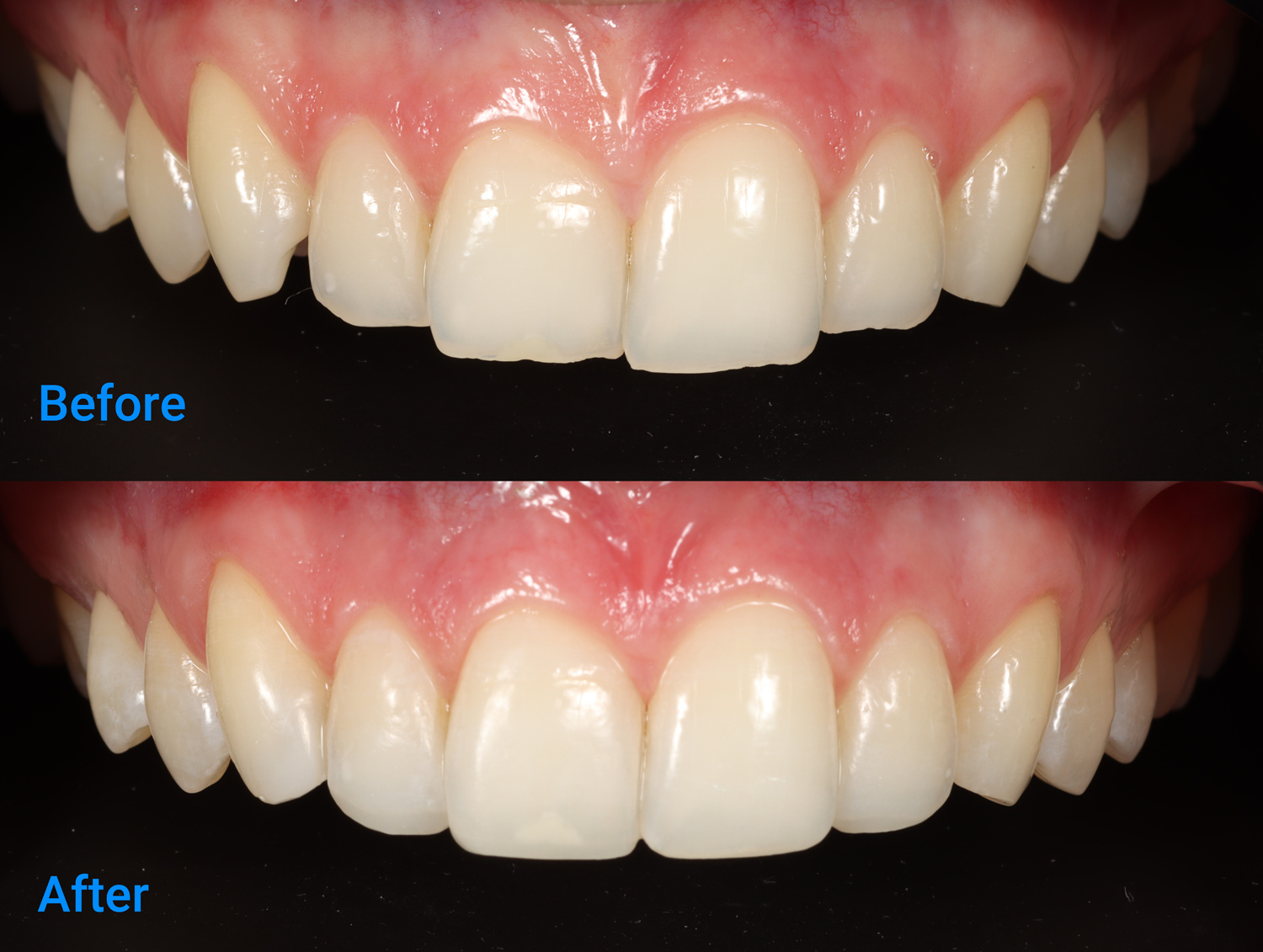 Invisalign before and after image.